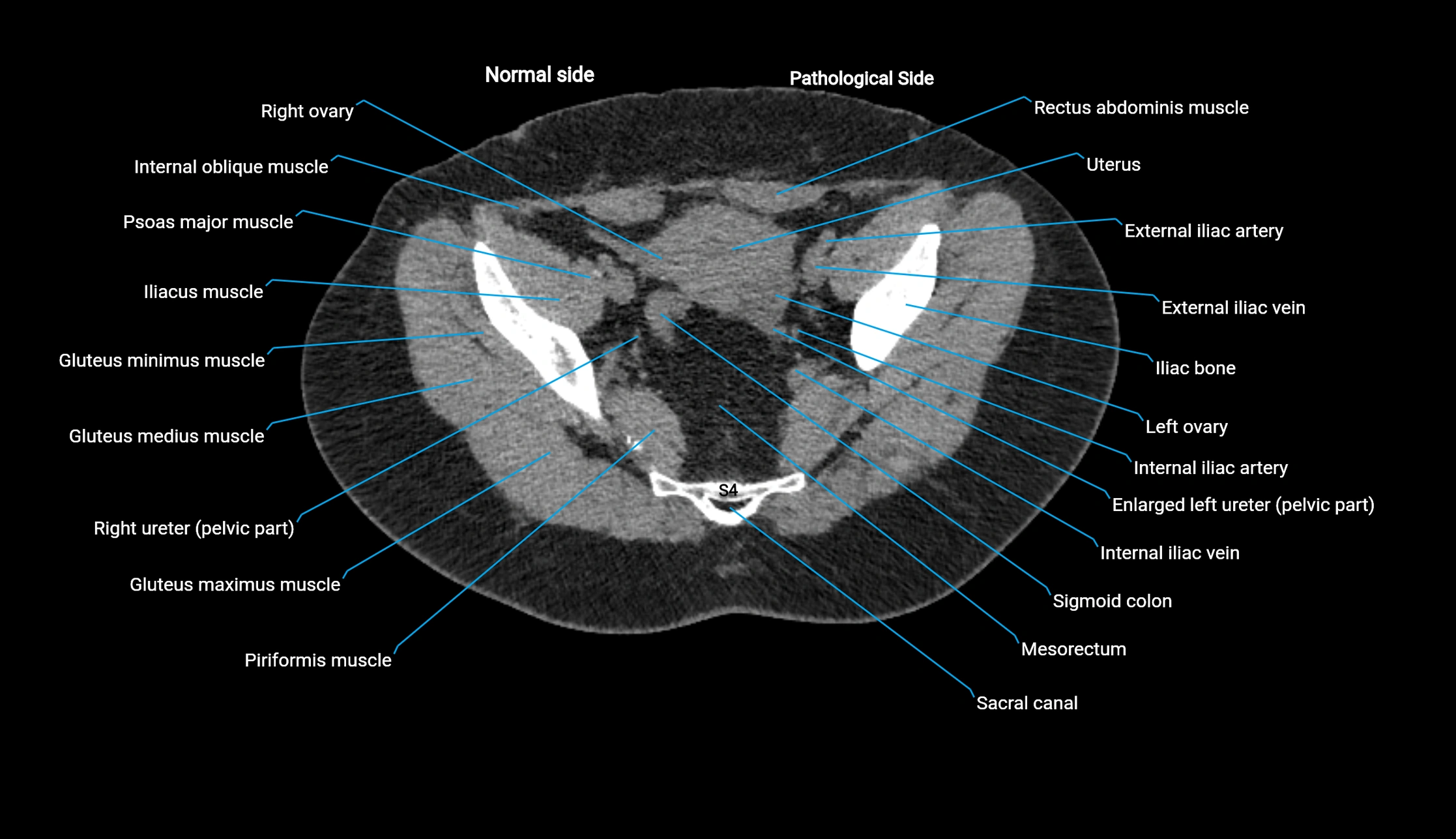 CT KUB axial cross sectional anatomy  radiology image -img-00201-00137.webp